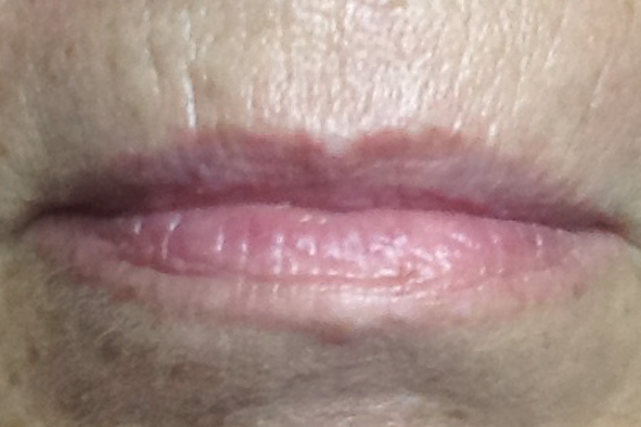 Lippen vor der Pigmentierung